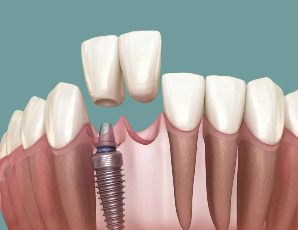 Top 5 Reasons Dental Implants in London Fail – Explained by a Leading Cosmetic Dentist